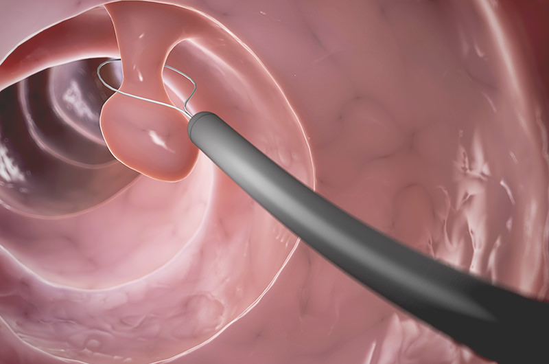 日帰り大腸ポリープ切除について