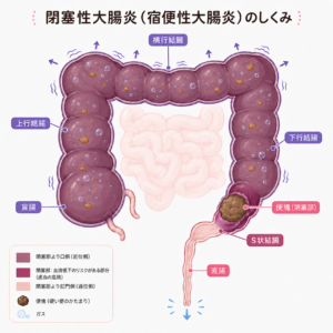 S状結腸の便塊によって口側の大腸が拡張し、血流低下や壊死リスクを示す暗紫赤色に変化した閉塞性大腸炎の模式図
