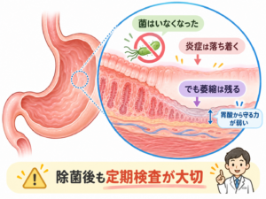 ピロリ菌除菌後の胃のイラスト。除菌によってピロリ菌が消え、胃粘膜の炎症は落ち着くものの、萎縮性胃炎による粘膜の変化が残る様子を断面図で解説。除菌後も胃がんのリスクはゼロにならないため、定期的な胃カメラ検査が大切であることを示している。