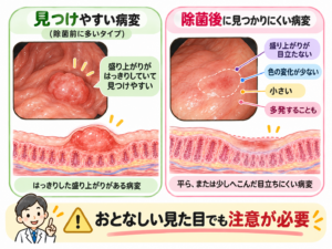 胃カメラで見た胃がん病変の比較イラスト。左は盛り上がりが明瞭で見つけやすい病変、右はピロリ菌除菌後にみられる平坦で浅いくぼみ、わずかな赤み、小ささなどが特徴の見つけにくい病変を、胃粘膜の断面図とともに解説。